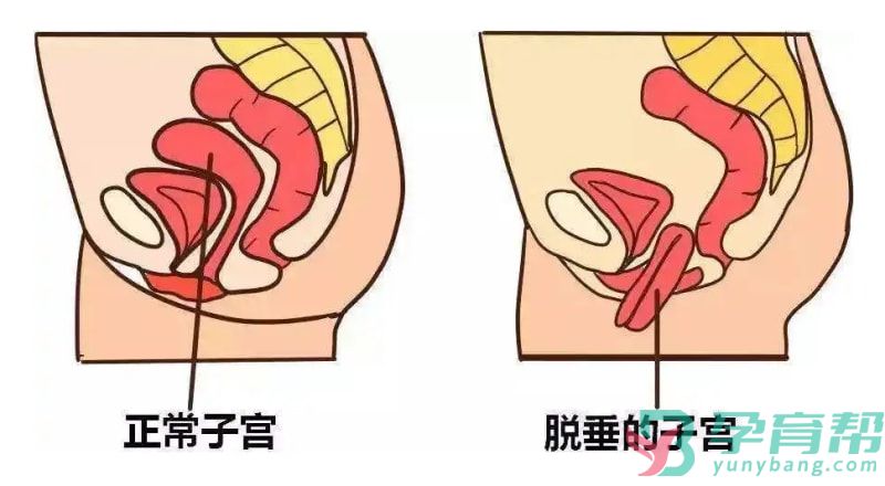 子宫脱垂症状(图1)