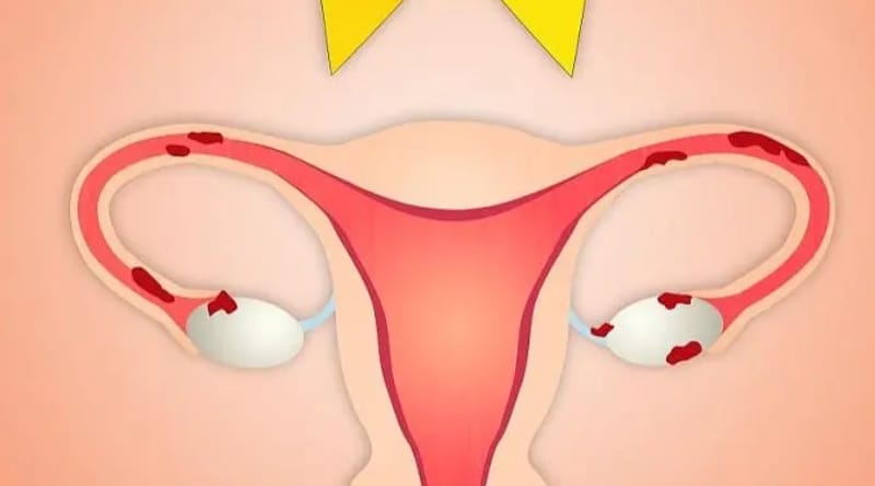 有正常卵巢无子宫的石女可以取卵做试管吗？