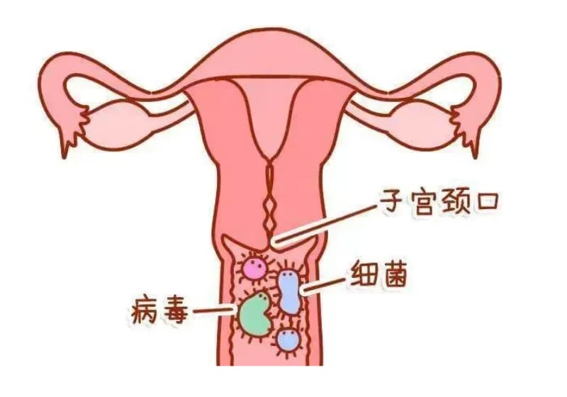宫颈炎的症状？（宫颈炎的治疗方法）(图1)