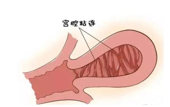 宫腔粘连影响胚胎试管移植吗女性？(图1)